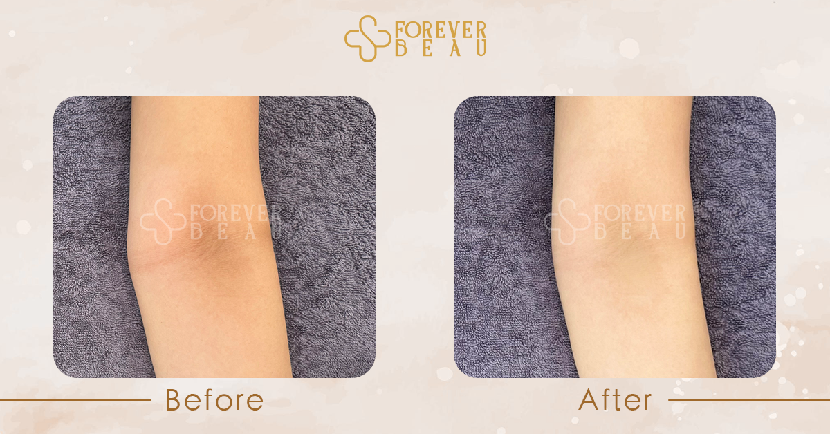 ForeverBeau_BeforeAfter_1